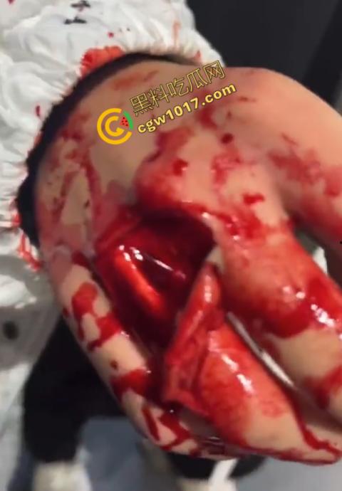 血腥慎点!社会混混残忍虐打小伙,马桶刷戳脸,铁管刺手,手背戳破血肉模糊,骨头暴露,惨不忍睹,令人心寒!-10