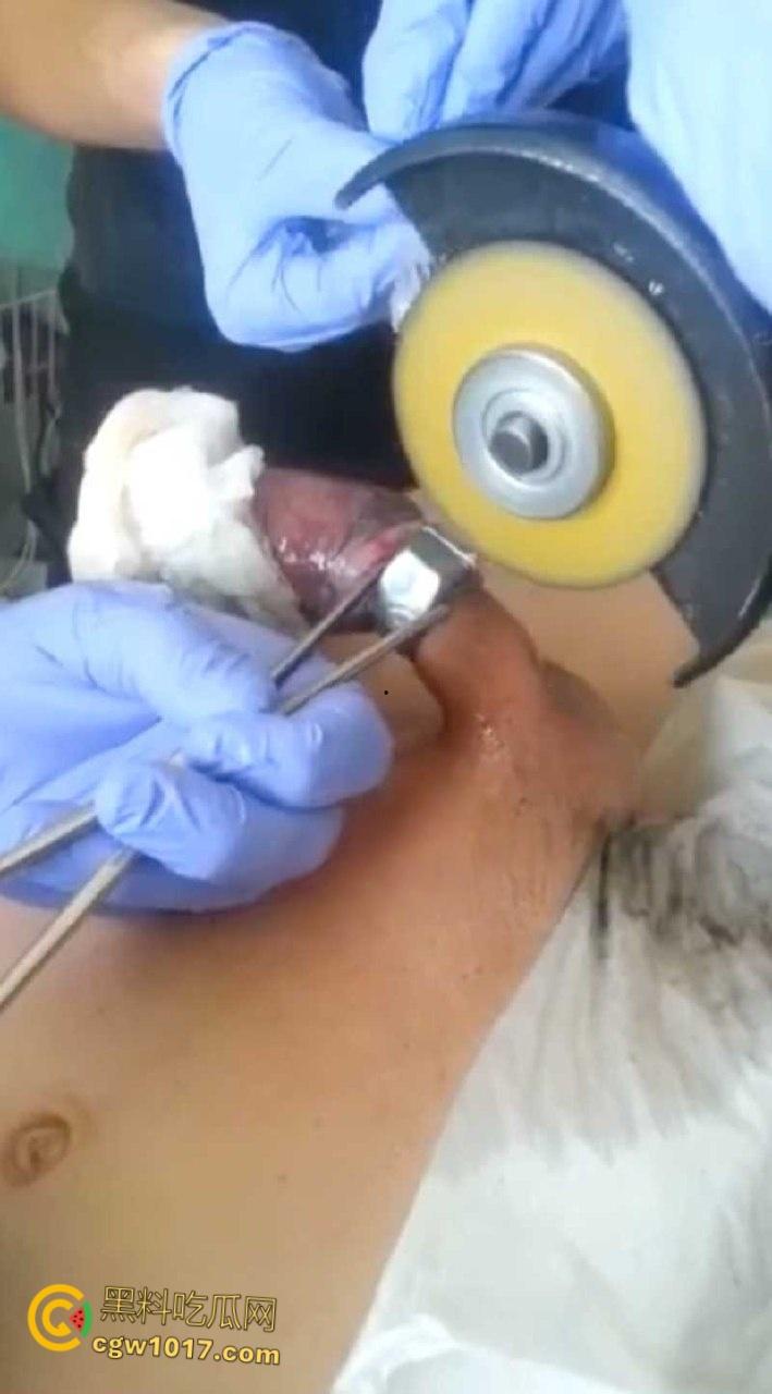 小说照进现实,男子追求刺激螺母自慰,勃起后被螺母卡住,消防人员和医生同时出动,解救被困阴茎 !-4