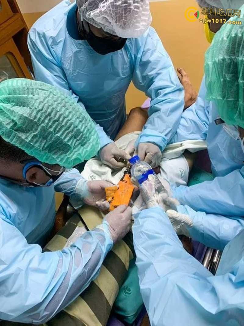 小说照进现实,男子追求刺激螺母自慰,勃起后被螺母卡住,消防人员和医生同时出动,解救被困阴茎 !-3