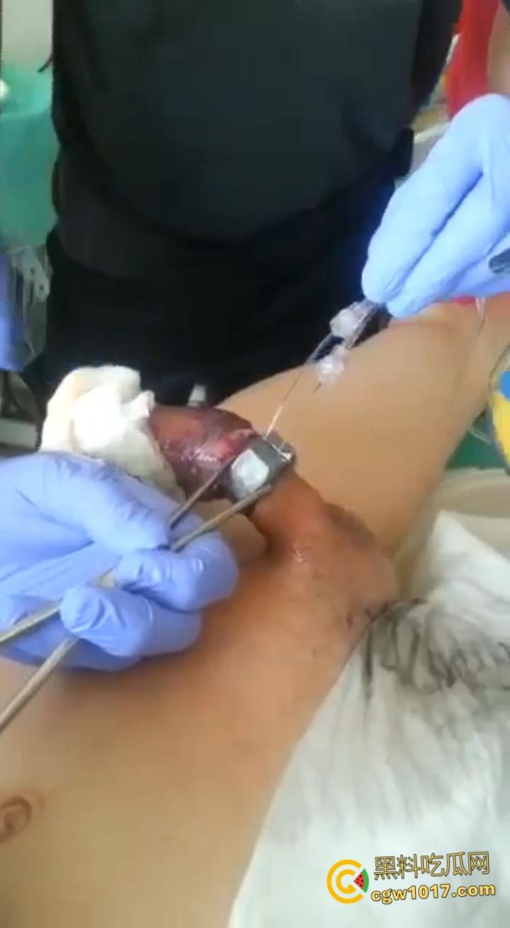 小说照进现实,男子追求刺激螺母自慰,勃起后被螺母卡住,消防人员和医生同时出动,解救被困阴茎 !-5