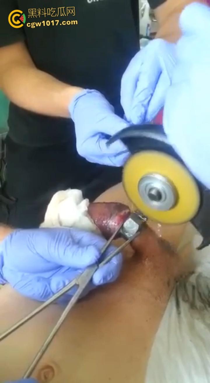 小说照进现实,男子追求刺激螺母自慰,勃起后被螺母卡住,消防人员和医生同时出动,解救被困阴茎 !-6