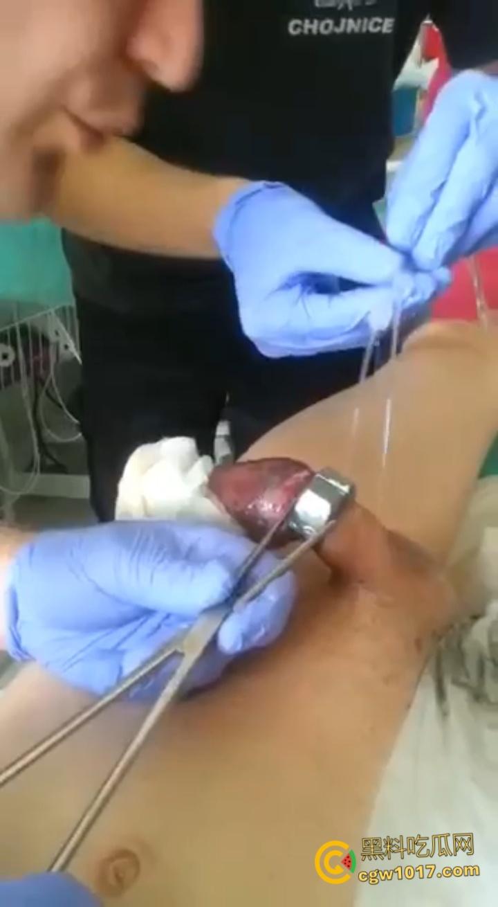 小说照进现实,男子追求刺激螺母自慰,勃起后被螺母卡住,消防人员和医生同时出动,解救被困阴茎 !-7